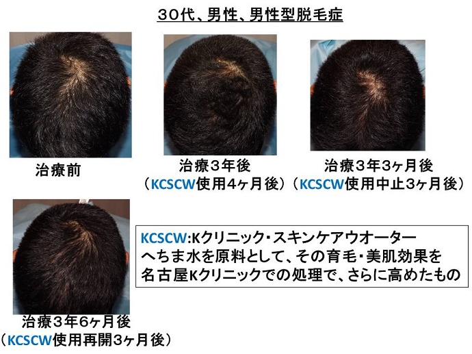 円形脱毛症　病院""